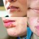 Sifilis na usnama: uzroci, simptomi i liječenje Primarni sifilis na usnama