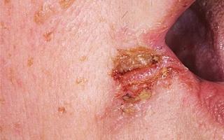รอยกัดและรอยแตกที่มุมปาก (angulitis, angular cheilitis, stomatitis เชิงมุม)