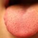 Was bedeutet der gelbe Belag auf der Zunge?