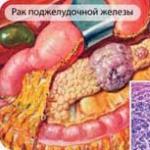 Patogenia cancerului de cap pancreatic Etiologia cancerului pancreatic