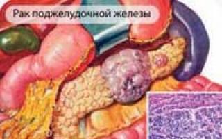 Patogenia cancerului de cap pancreatic Etiologia cancerului pancreatic