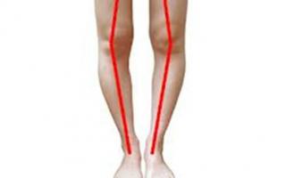 ความผิดปกติของกระดูกโคนขา Varus deformity ของคอกระดูกต้นขาในเด็ก