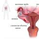 Boleče menstruacije - je možno in potrebno zdraviti