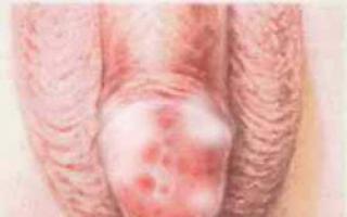 Balanopostitis: tratamiento en hombres, fotos, formas y vías de infección.