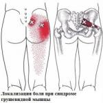 Как снять спазм и расслабить грушевидную мышцу и седалищный нерв в домашних условиях